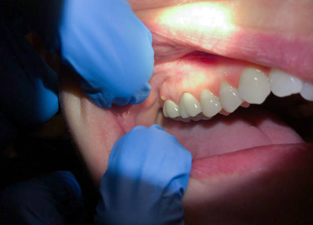 Best Root Canal Emergency Dentist  in Byram, MS
